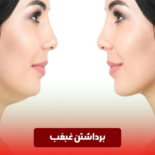 جراحی حذف غبغب