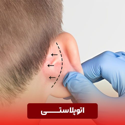 اتوپلاستی